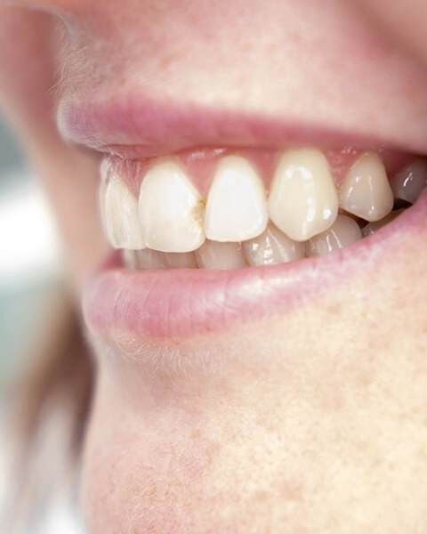 Cracked front tooth to be fixed with composite bonding